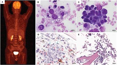 Intravascular large B-cell lymphoma as a covert trigger for hemophagocytic lymphohistiocytosis complicated with capillary leak syndrome: a case report and literature review
